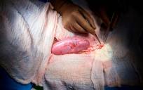 Consiguen trasplantar un riñón de cerdo a un humano