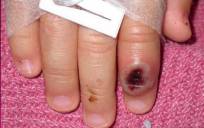 Fotografía del Centro Estadounidense de Control de las Enfermedades (CDC) en la que se aprecia el dedo de un niño infectado por la "viruela de mono". / EFE