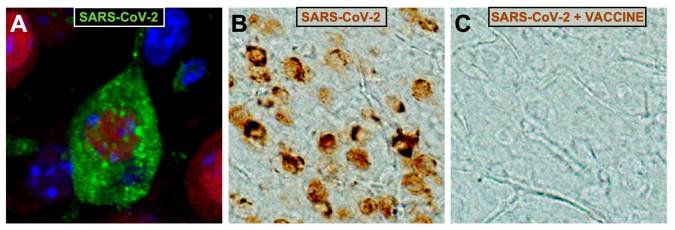 Imágen A Neurona de la corteza cerebral infectada por el coronavirus SARS-CoV-2 (partículas virales en verde). En B, neuronas corticales infectadas por SARS-CoV-2 (en marrón) y, en C, ausencia de infección en la misma región cerebral de ratones vacunados con MVA-CoV2-S. EFE/IBiS