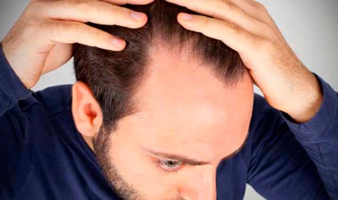 Advierten de un alarmante incremento de la caída del cabello en el confinamiento