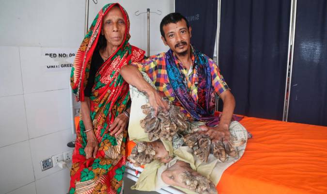 Abul Bajandar, el bangladesí que sufre una rara enfermedad genética por la que es conocido como el «hombre árbol», espera junto a su madre para ser tratado en un hospital de Dacca. EFE/EPA/Monirul Alam