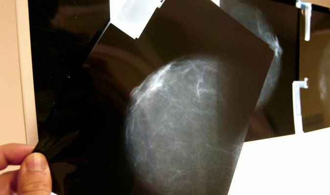El impacto covid en cáncer: Sanidad prevé más casos de pulmón, mama y colon