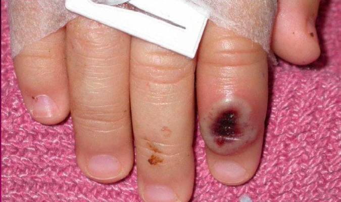 Fotografía del Centro Estadounidense de Control de las Enfermedades (CDC) en la que se aprecia el dedo de un niño infectado por la llamada «viruela de mono». / EFE