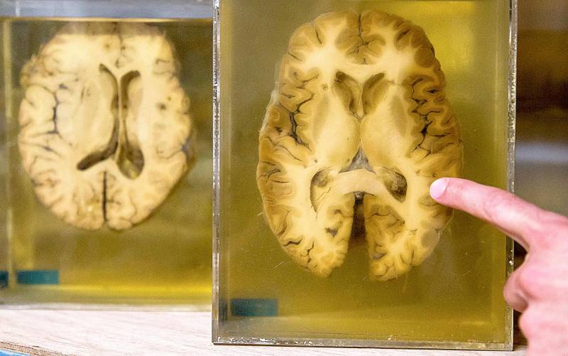 Imagen de archivo de una parte del cerebro tras una disección EFE/Stephanie Lecocq